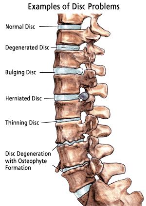 What are some exercises that help a compressed vertebra?